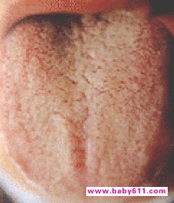 舌苔厚黄 舌苔厚黄