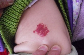 Ӥ�׶�Ѫ����Ӧ����λ���?