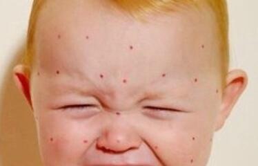 要避免皮肤湿疹