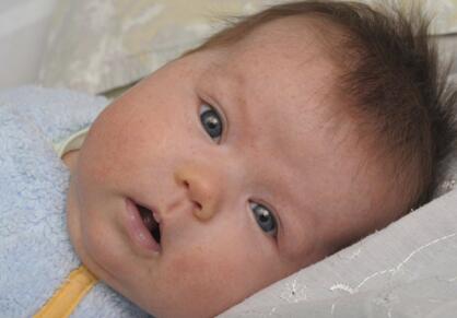 家长必知 如何鉴别婴儿湿疹