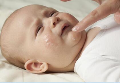 推荐四种人气婴儿湿疹偏方