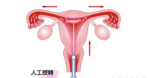 什么是人工受孕 人工受孕的注意事项