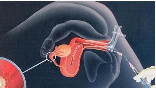 什么是人工受孕 人工受孕的注意事项