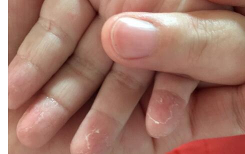 宝宝手总蜕皮是缺维生素吗