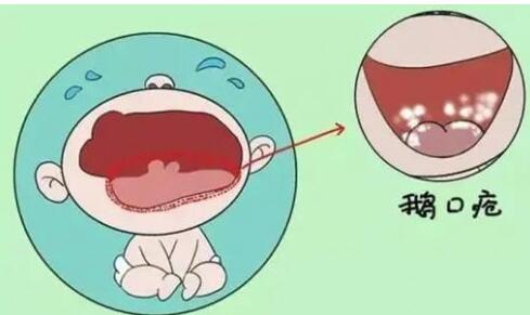 小儿鹅口疮的症状有哪些?