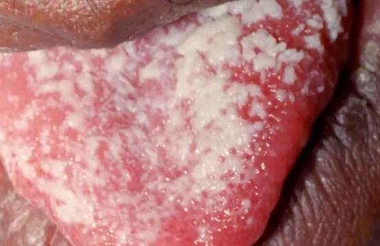 那是鹅口疮!不是顽固奶渣!这么治才对!