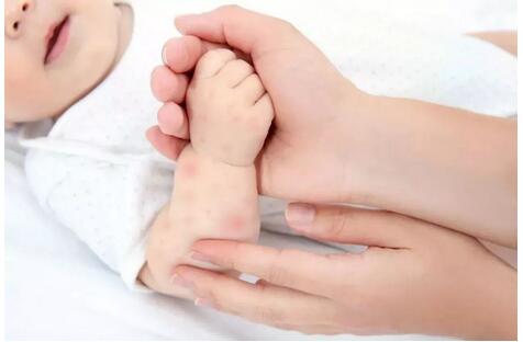 婴幼儿食物过敏的3大危险因素