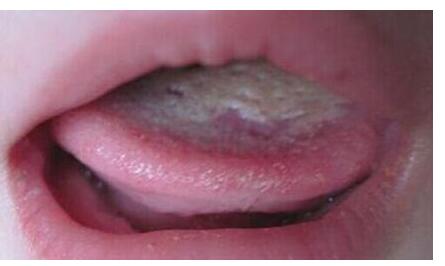 干货!一文读懂新生儿鹅口疮