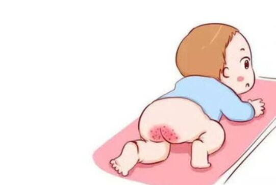 宝宝屁股“着火”6大原因,4个方法正确预防!