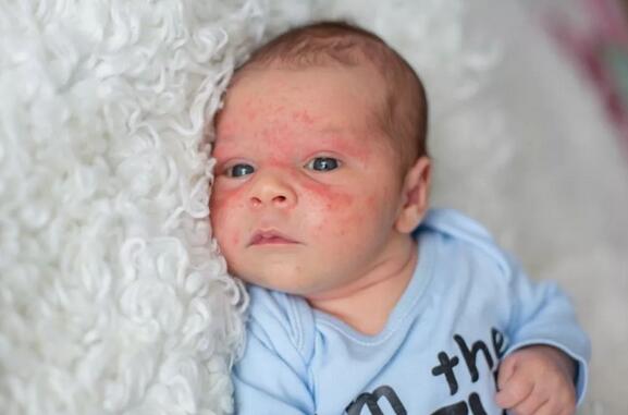 婴儿湿疹护理的七个小妙招,家长需牢记!