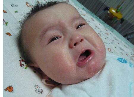 宝宝湿疹没有护理好,也会酿成大祸!家长切莫大意!