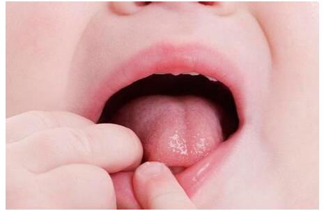 学会看宝宝舌头健康“晴雨表”,做父母的要了解清楚!