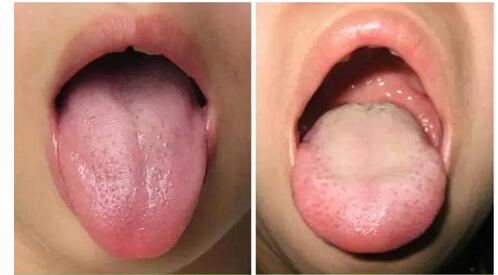 宝宝舌苔又厚又白?家长不容忽视!